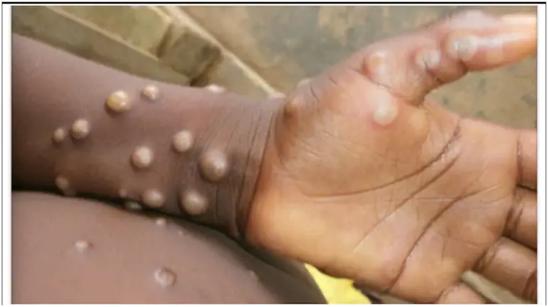 Study finds current monkeypox symptoms different from those in earlier outbreaks